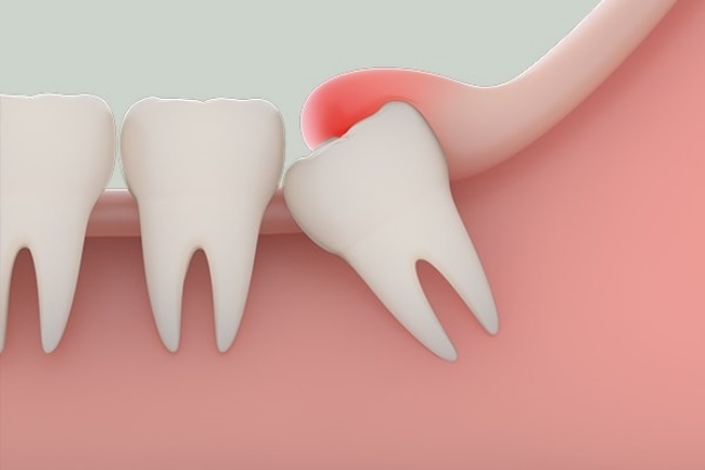 Nhổ răng khôn: Những điều cần biết