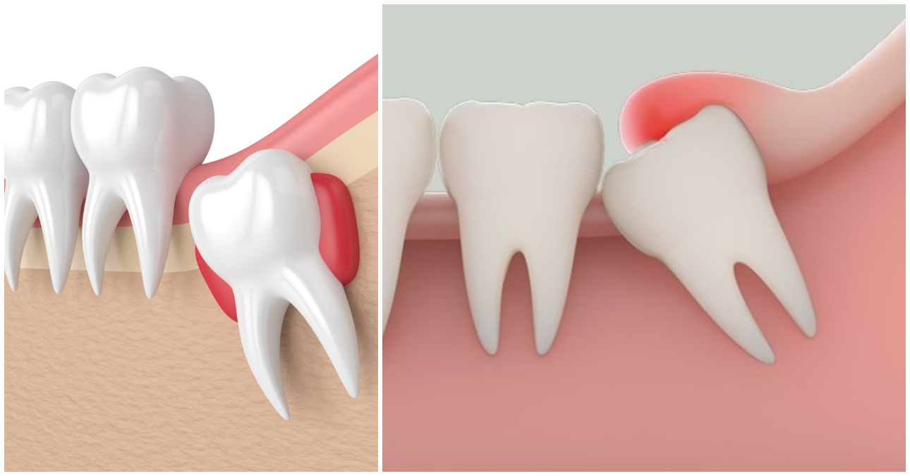Nhổ răng khôn: Những điều cần biết