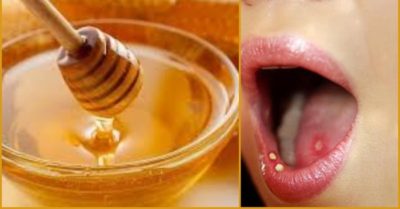 Chữa nhiệt miệng bằng mẹo vặt đơn giản