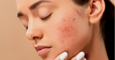 Cách trị mụn an toàn hiệu quả từ nguyên liệu thiên nhiên