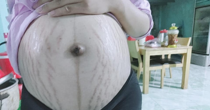 Làn da của phụ nữ  khi mang thai sẽ có những sự thay đổi rất nhiều và thường bị kéo căng trong suốt thai kỳ, làm xuất hiện các vết nứt quanh vùng bụng, hông và đùi. da là