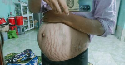 Bụng bầu rạn nứt tung tóe của mẹ trẻ, khiến ai nhìn cũng thương