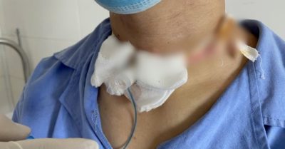 Chạy xe, thanh niên vướng dây công trình bị đứt lìa khí quản… mà không biết