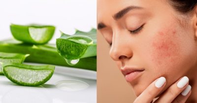 Cách trị mụn bằng nha đam hiệu quả tại nhà