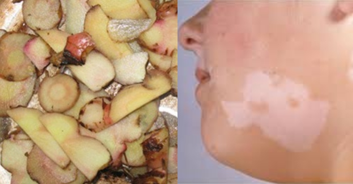 Lang ben là một bệnh nhiễm nấm Pityrosporum ovale ngoài da thường gặp. Gây mất thẩm mỹ vì những mảng da sáng màu.