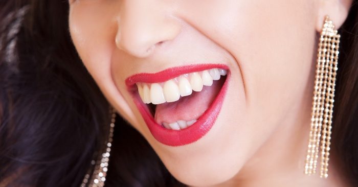 Tẩy trắng răng là phương pháp nha khoa dùng các chất oxy hóa kết hợp với năng lượng ánh sáng, sẽ tạo ra phản ứng oxy hóa, làm cắt đứt các chuỗi phân tử màu trong ngà răng; giúp răng trắng sáng hơn so với màu răng ban đầu.