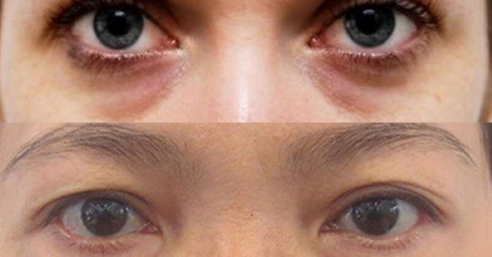 4 cách tự nhiên giảm nếp nhăn và bọng mắt